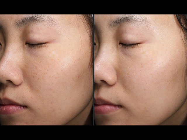 星皮秒雷射效果